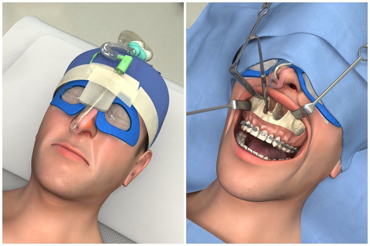 Cech facial surgery