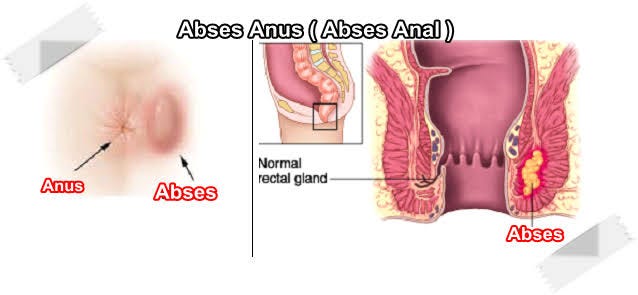 Painful lump near anus