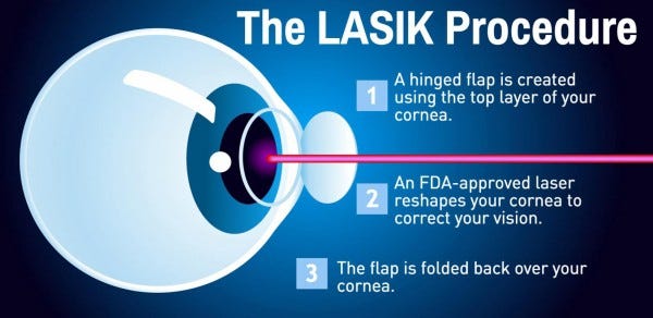 Lasik Eye Surgery Cost In Korea Is A Fascination For Everyone