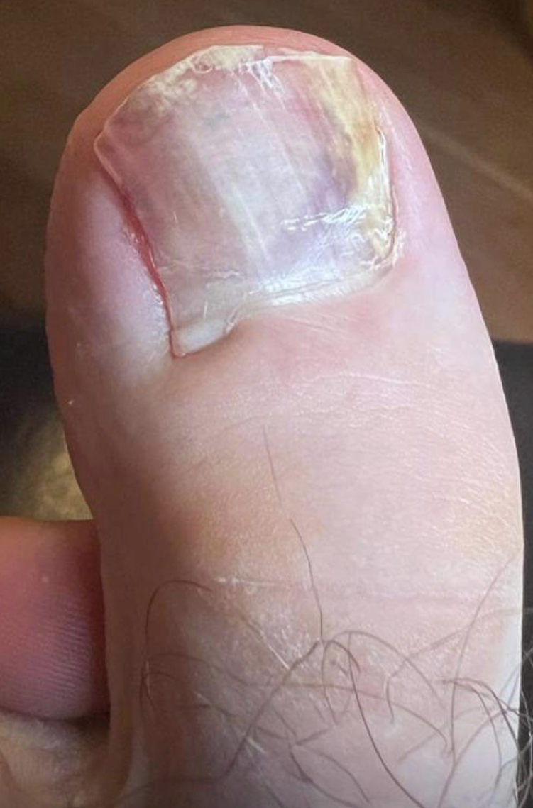 Nail Avulsion Care: Essential Tips for Faster, Safe Healing