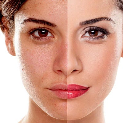 Pigmentation Treatments