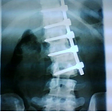 Scoliosis and Mental Health: My Lived Experience
