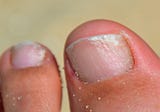 A New Treatment For Fungal Nails