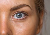 Help, I have Blepharitis!