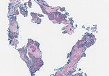 Follicular Dendritic Cell Sarcoma