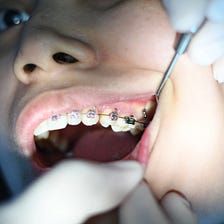 4 Reasons To Ditch Traditional Braces In 2022