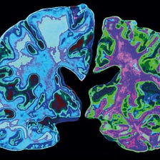 Brain Technologies and Alzheimer’s Disease
