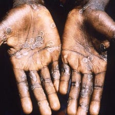 Why Monkeypox Hasn’t Killed Anybody in Non-African Countries With Its Case Fatality Rate of 1–10%