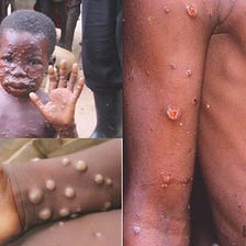 there is a case of monkeypox recorded Ghana?