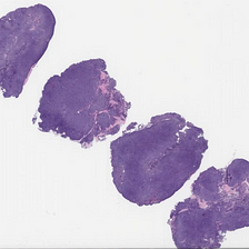 Mantle Cell Lymphoma, Nodular Pattern