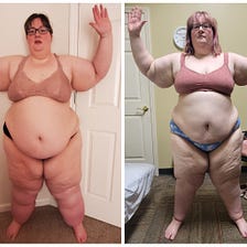 6 Weeks Post-Op Lipedema Liposuction