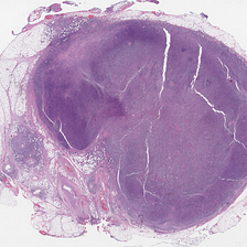 Nodal T-Follicular Helper Cell Lymphoma, Angioimmunoblastic-Type