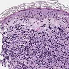 NK/T-Cell Lymphoma, Nasal Type