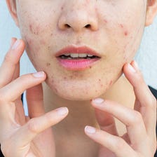 How i wiped out ACNE permanently