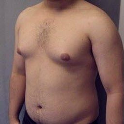 Get Rid Of Man Boobs