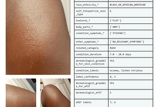 Semantic Understanding of Dermatology Images Using LLaVA and RAG