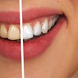 Image of before and after teeth whitening