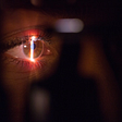 An eye being treated with laser
