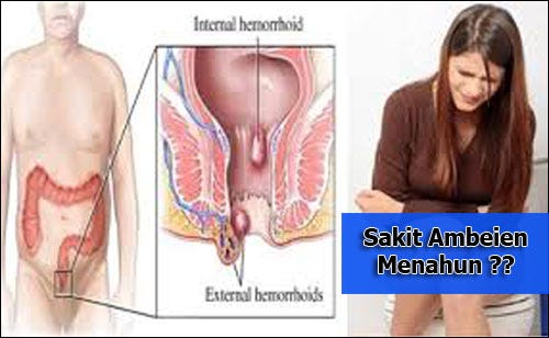 Wasir bisa terjadi karena