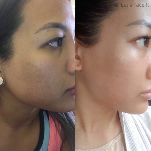 the ordinary blackheads before and after