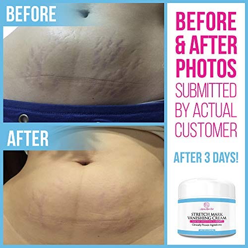 mommy knows best stretch mark vanishing cream