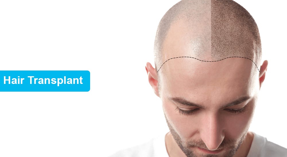 What Is Hair Transplant Hair Transplant In Turkey Medium