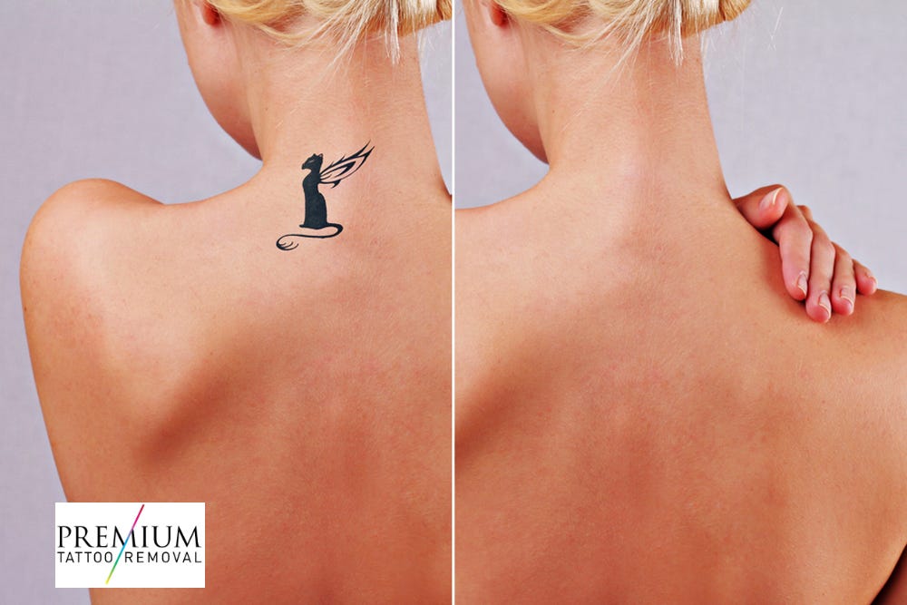 Laser Therapy Is Today The Best Solution To Remove Body Tattoos By Premium Tattoo Removal Medium