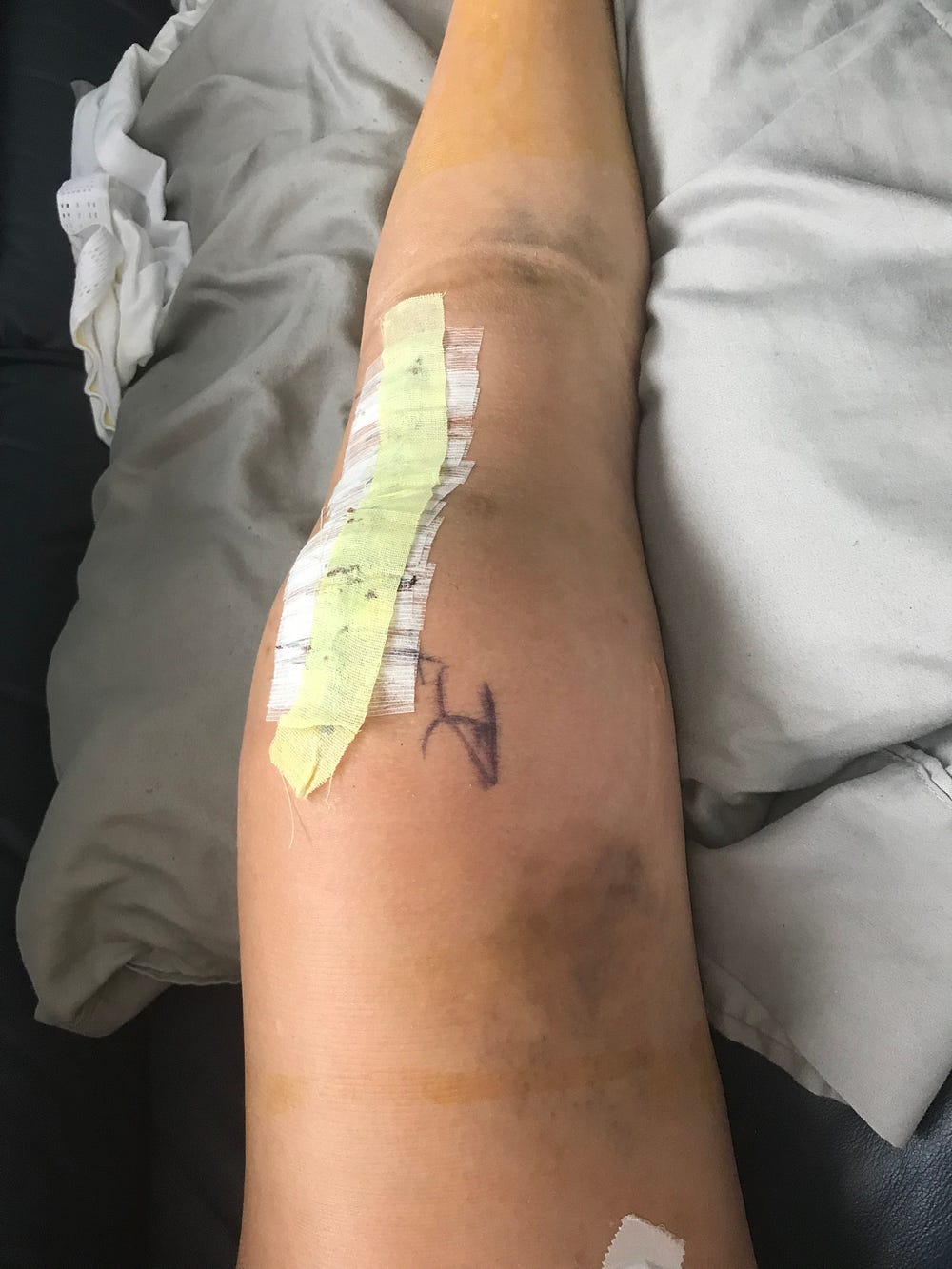 The Haunting Of Arthrofibrosis Two Minutes To Go In The Final Game Of By Alayna Hess Alayna S Hot Takes Medium The Haunting Of Arthrofibrosis Two Minutes To Go In The Final Game Of By Alayna Hess Alayna S Hot Takes Medium