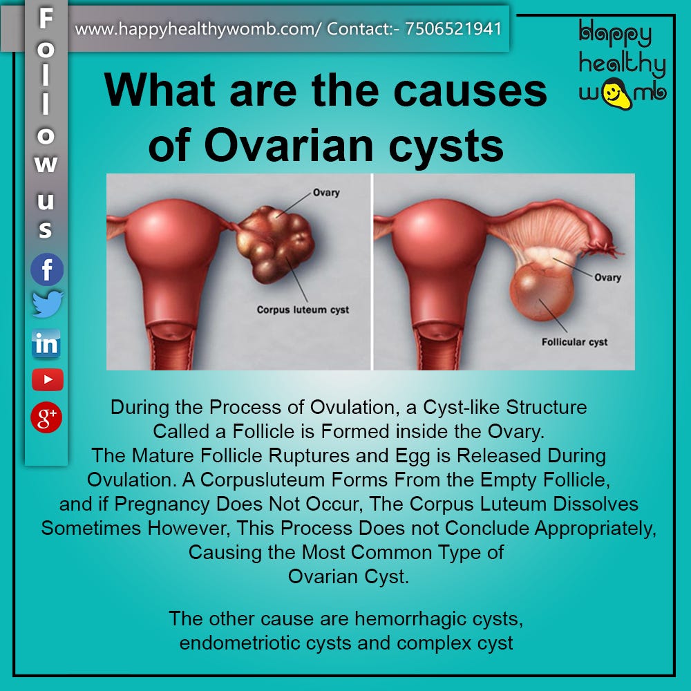 Ovarian Cust Anatomy