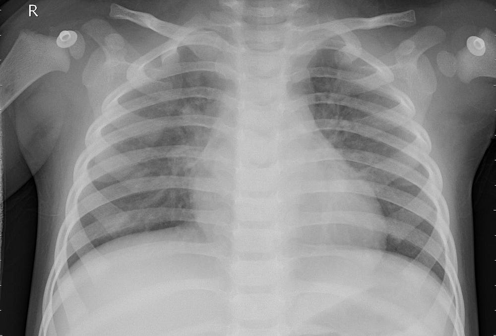 Diagnosing Pneumonia with Transfer Learning - Jack Risse - Medium