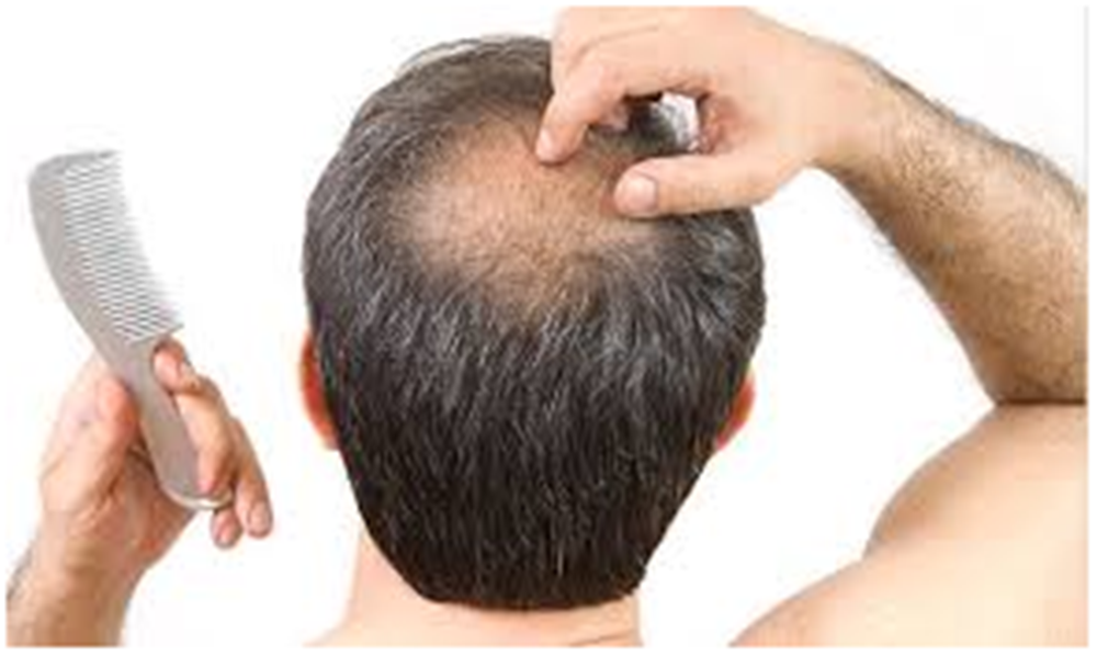 Diet Tips To Prevent Balding Hair Transplant Asia Medium