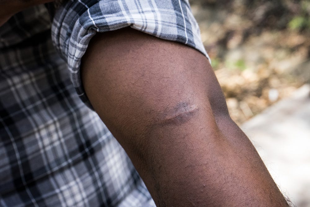 Some of the marks left on his skin from the ropes used to tight him for days.