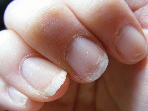 Cosa rivelano le unghie sulla nostra salute? | by Vincenza Barresi |  VincenzaNails | Medium