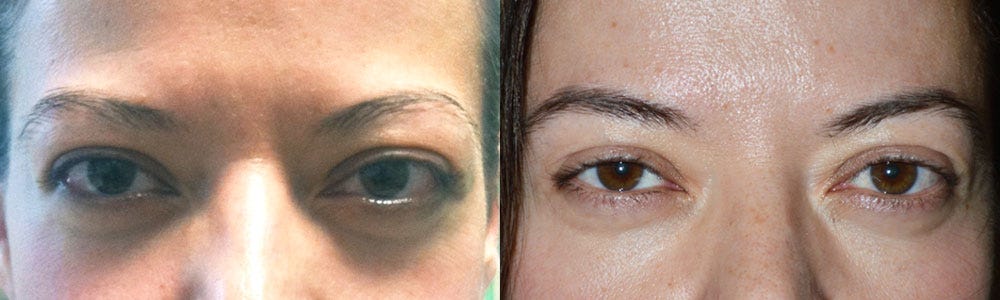 Get Best Treatment of Thyroid Eye Disease in Beverly Hills | by Taban