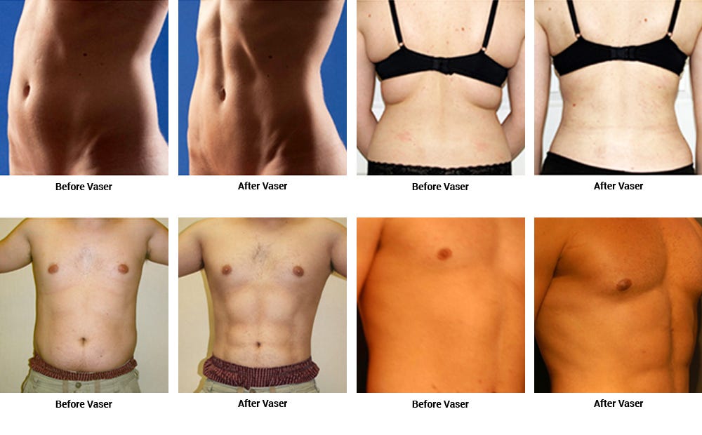 Vaser Lipo Laser Cost In India Laser Liposuction Cost In Delhi Vaser Lipo By Vaser India Medium Vaser Lipo Laser Cost In India Laser Liposuction Cost In Delhi Vaser Lipo By Vaser India Medium