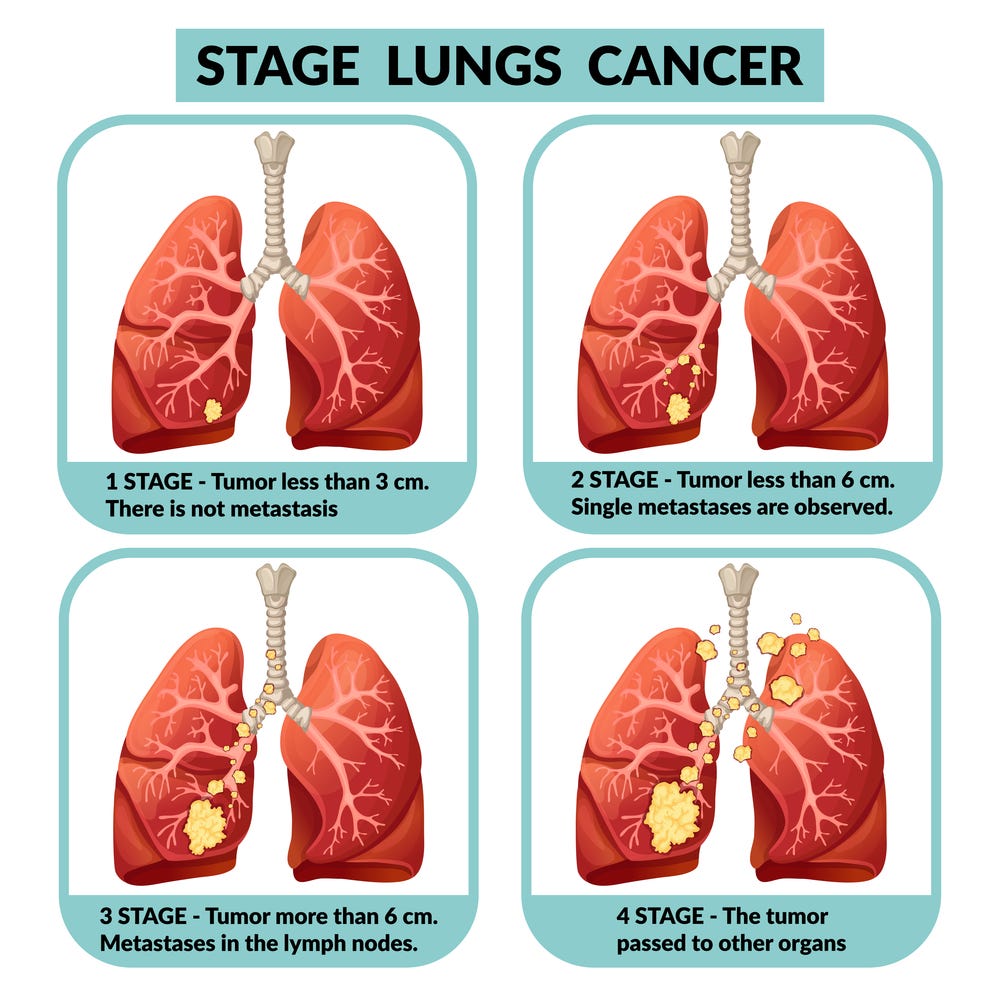 What Is The Best Treatment For Lung Cancer Stage 4? | by mayur raval ...