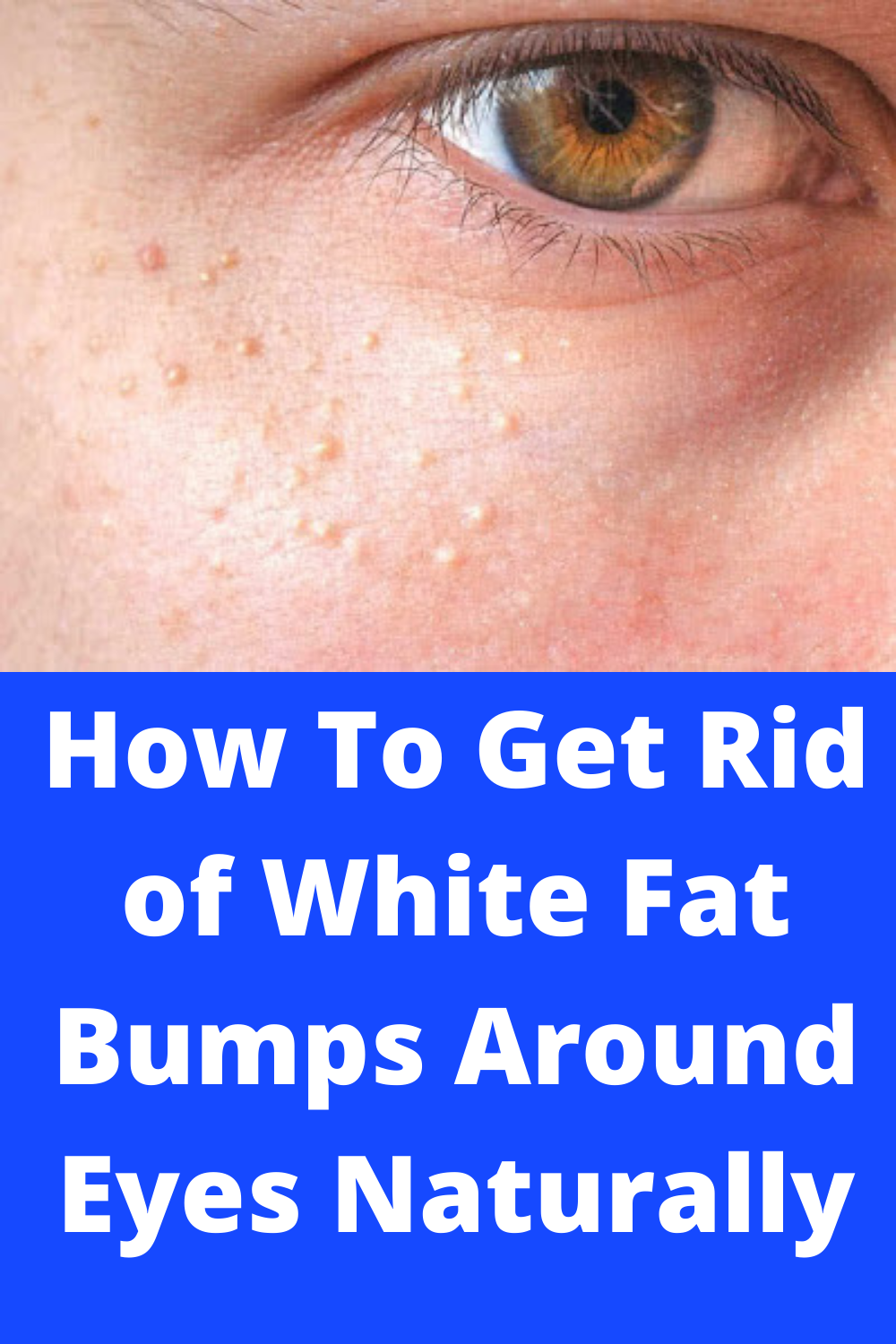How To Get Rid Of White Fat Bumps Around Eyes Naturally