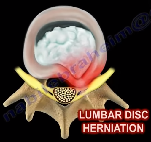 Robertson and spondylolisthesis 05 image