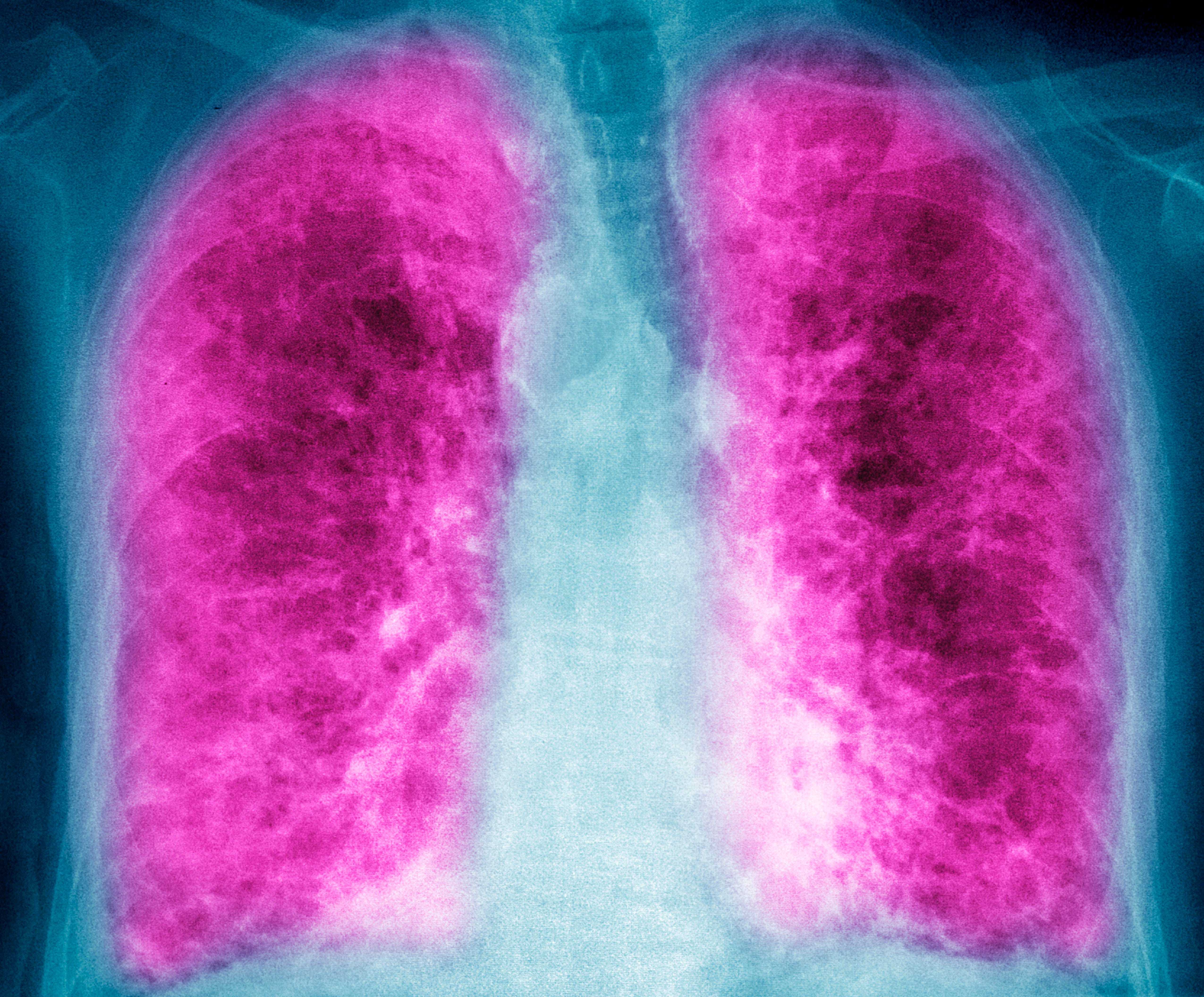 Breathing Practices And Qigong May Help Covid 19 Patients Recover Lung Function Elemental