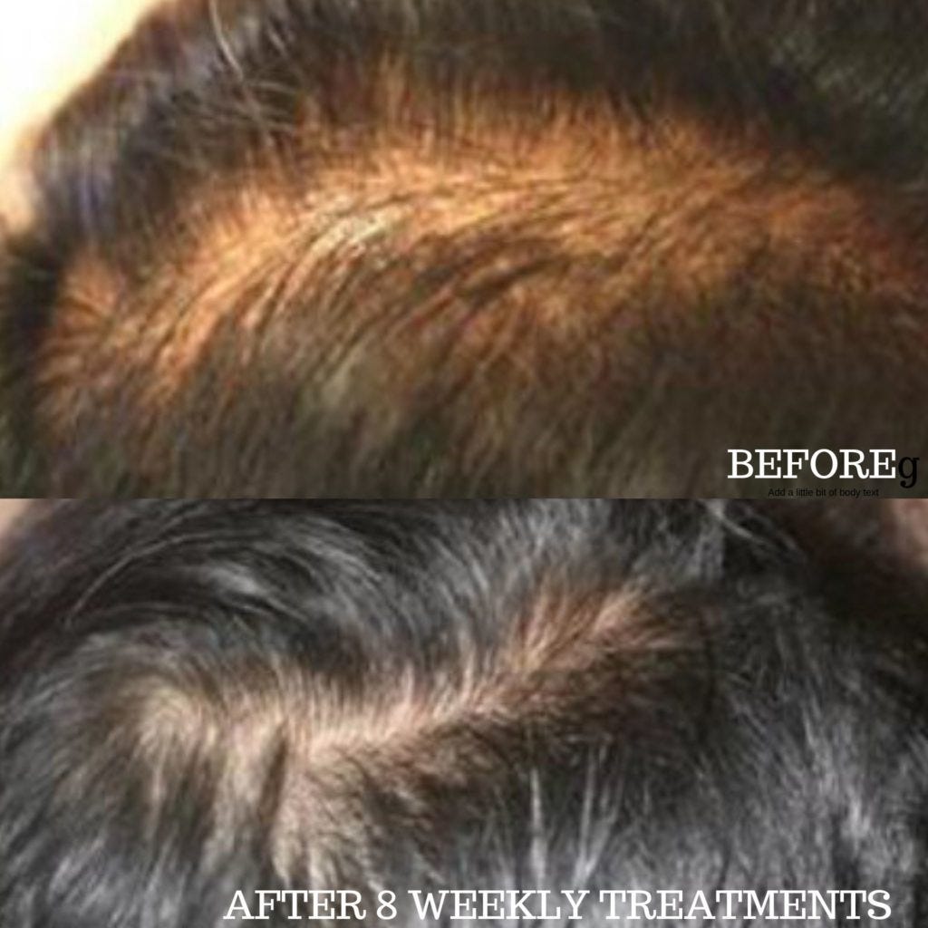 Hair Loss Repair And Vitamin Treatment In Ottawa Nakota Medispa