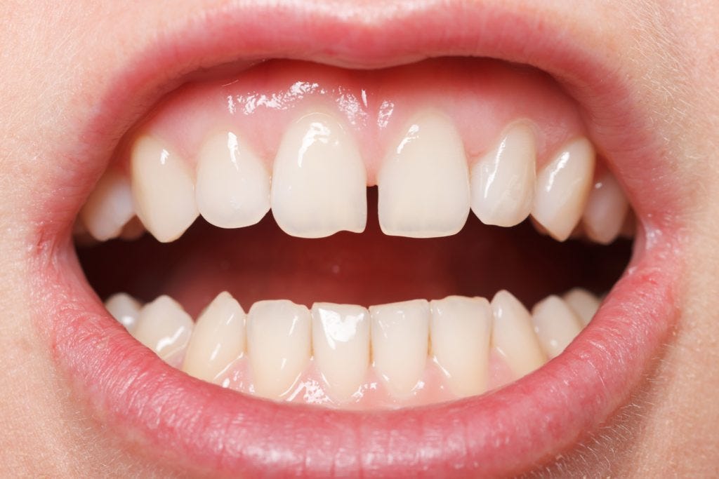 How to Grow Back Your Chipped Tooth by Mike Lehman Medium