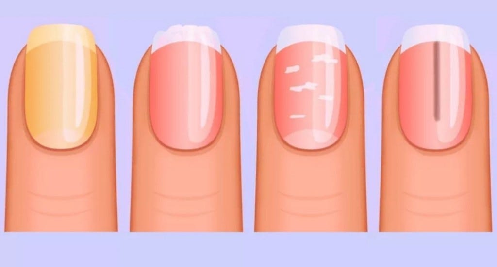 Cosa rivelano le unghie sulla nostra salute? | by Vincenza Barresi |  VincenzaNails | Medium