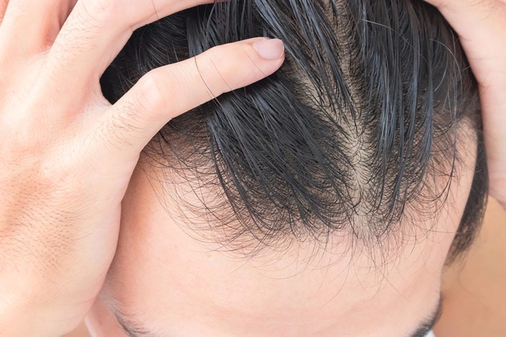 Thinning Hair Treatment Via Laser Mid Michigan Laser Medium