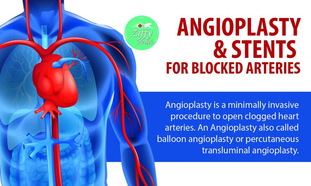 Angioplasty And Stents For Blocked Arteries By Ziffytech Medium
