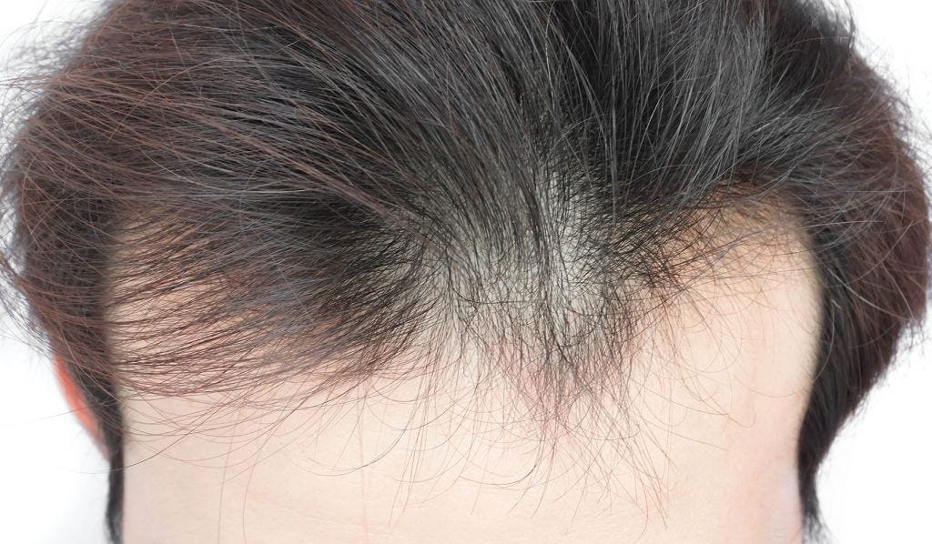 Thinning Hair Best Life Medium