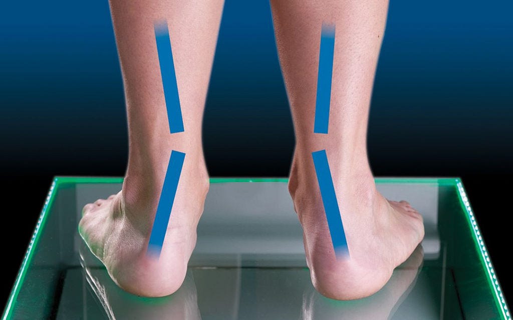 5 Easy Steps For Flat Feet Overpronation Treatment | by shape crunch |  Medium