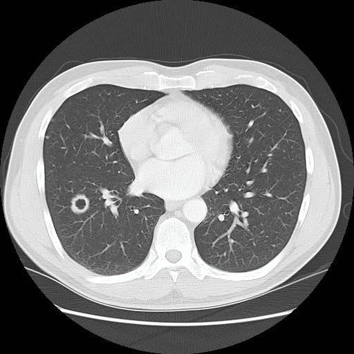 Image of author’s lungs showing a 2 cm lesion in his lower right lobe