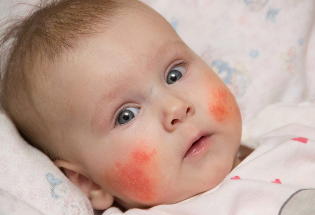 Eczema In Babies Treating Eczema Of The Hands Causes And Treatments By Nav Gosal Skin Care Tips Tricks Medium Eczema In Babies Treating Eczema Of The Hands Causes And Treatments By Nav Gosal Skin Care Tips Tricks Medium