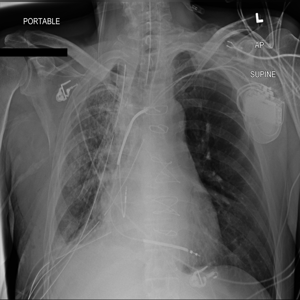Chest XRay Abnormality Classification Using Monk AI by Kushagra