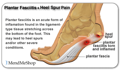 Arch and Heel and Ball of Foot Pain, Oh 